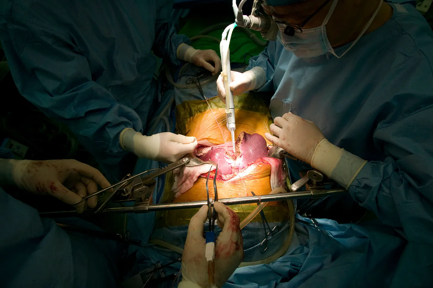 Surgeons performing a liver transplant.