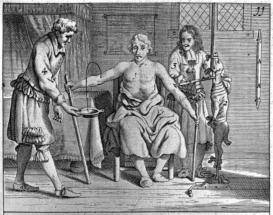 Illustration from Scultetus’ Armamentarium chirurgicum (1693)