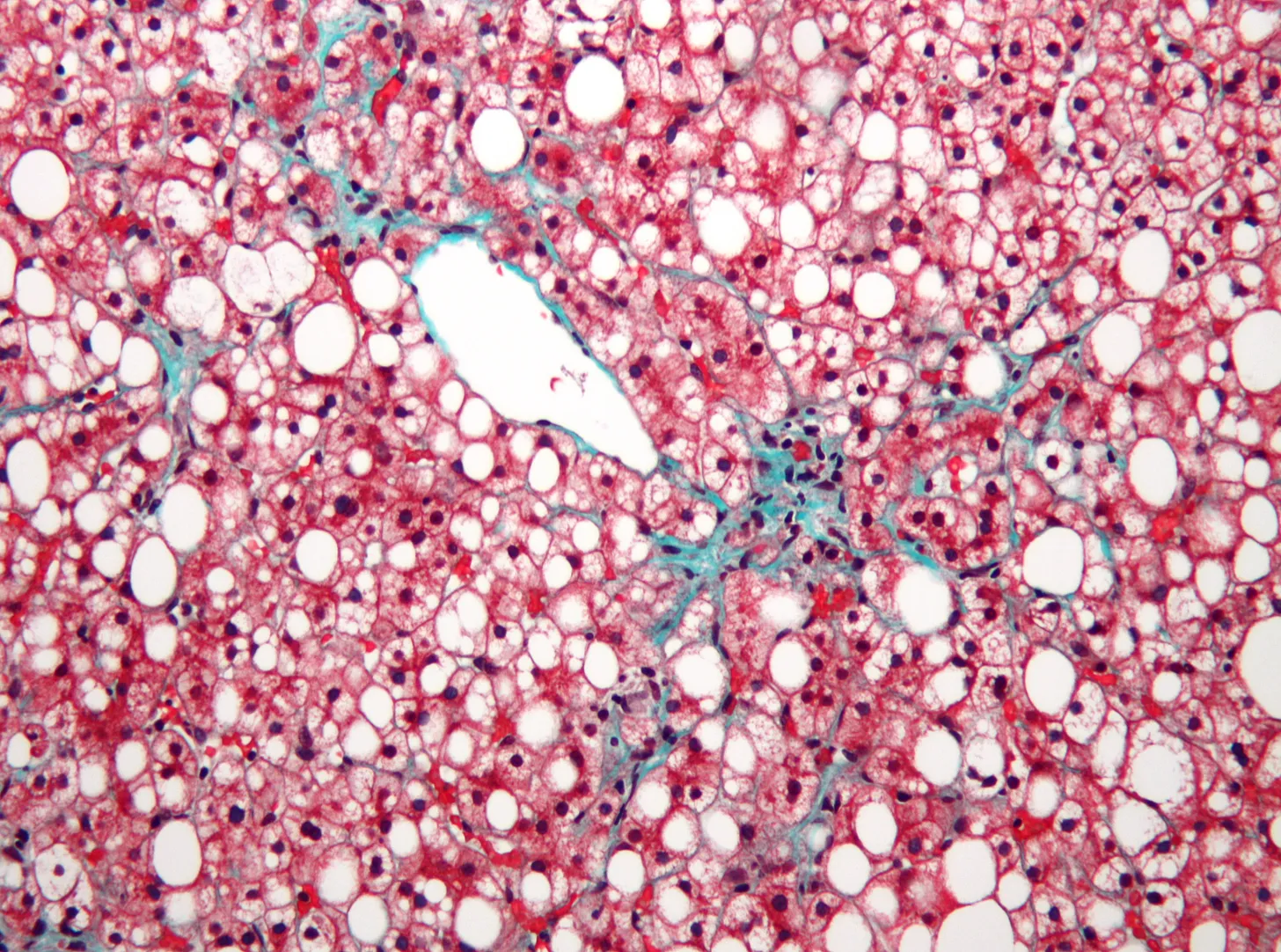 A section of liver with signs of non-alcoholic fatty liver disease.