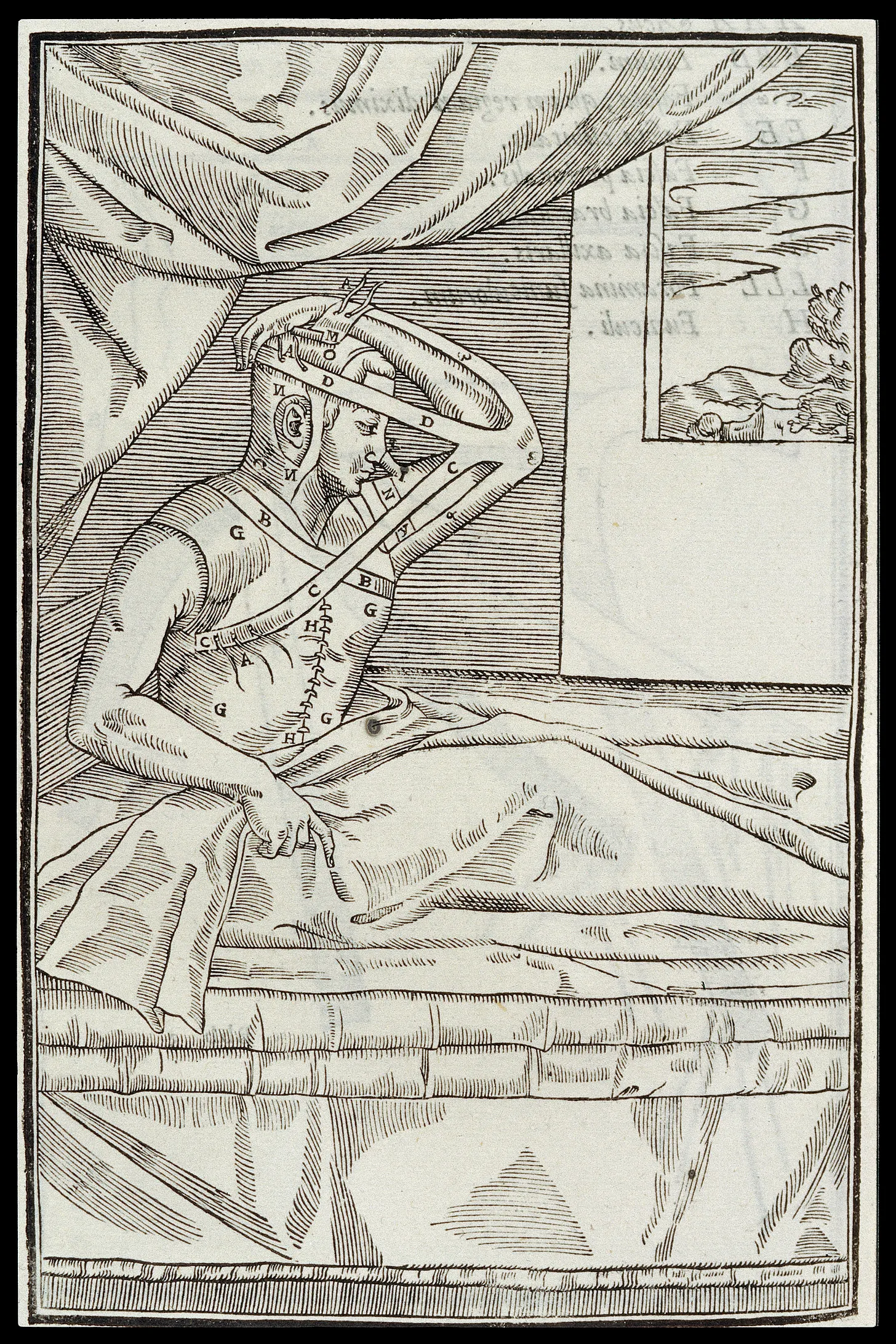 An illustration from Tagliacozzi’s 1597 work