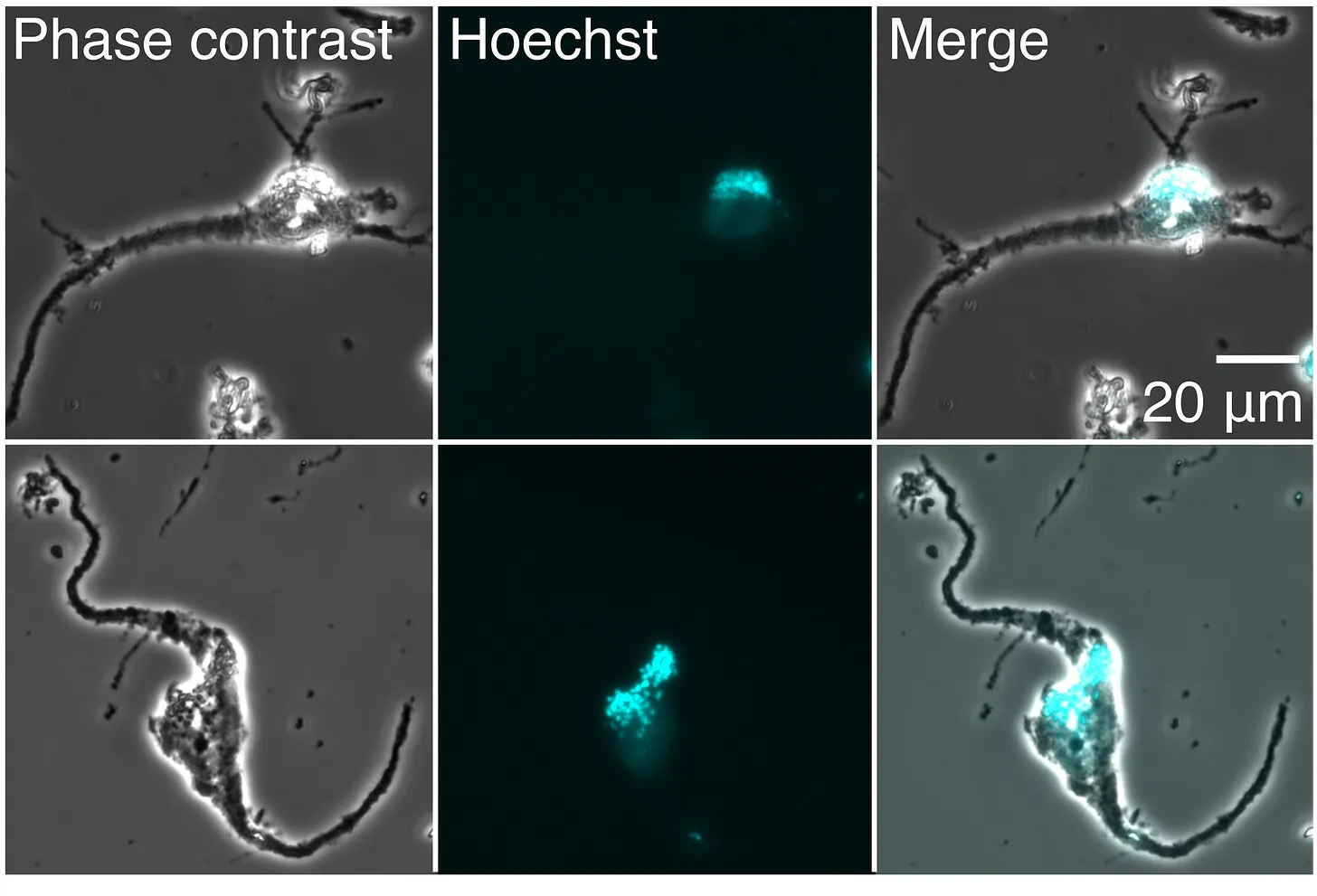 Neurons being isolated using a CellenONE machine and lysed open to study the proteins involved in Alzheimer's disease.