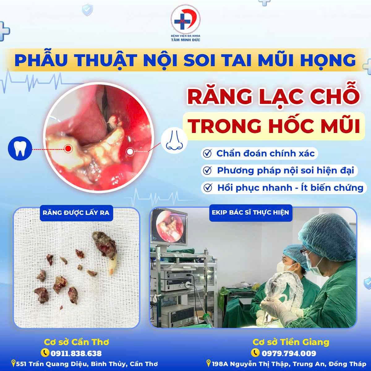 Phẩu Thuật Nội Sôi Tay Mũi Họng