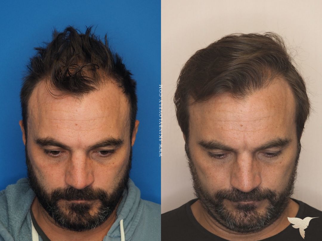 14+ Prf Hair Restoration