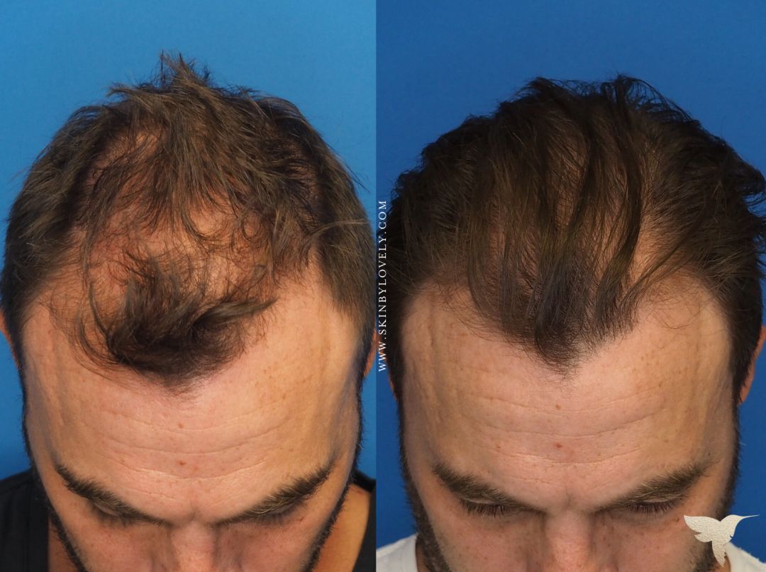 PlateletRich Fibrin PRF Hair  Skin Restoration in San Jose CA