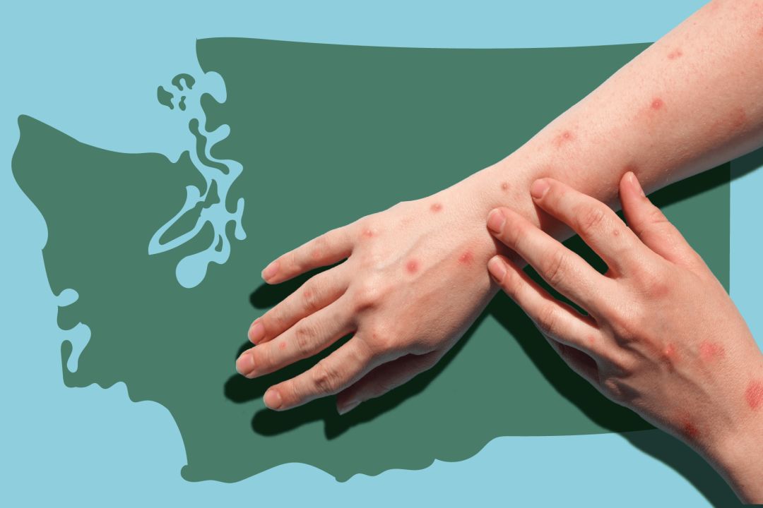 What to Know about the Monkeypox Outbreak in Seattle