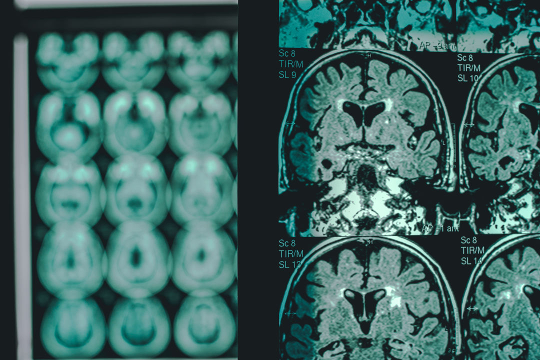 Alzheimer's Disease as shown on a MRI.