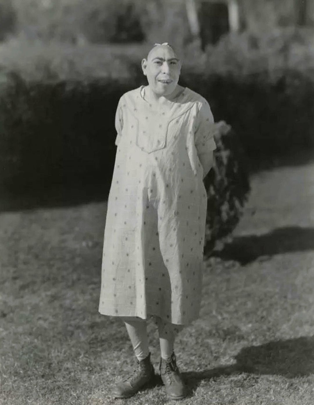 Schlitzie was a famous American sideshow performer who appeared in the 1932 movie Freaks and lived into her 80s. Fans still visit her grave.
