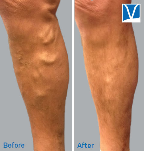 Varicose Veins: 7 Signs You Need to See a Vein Specialist