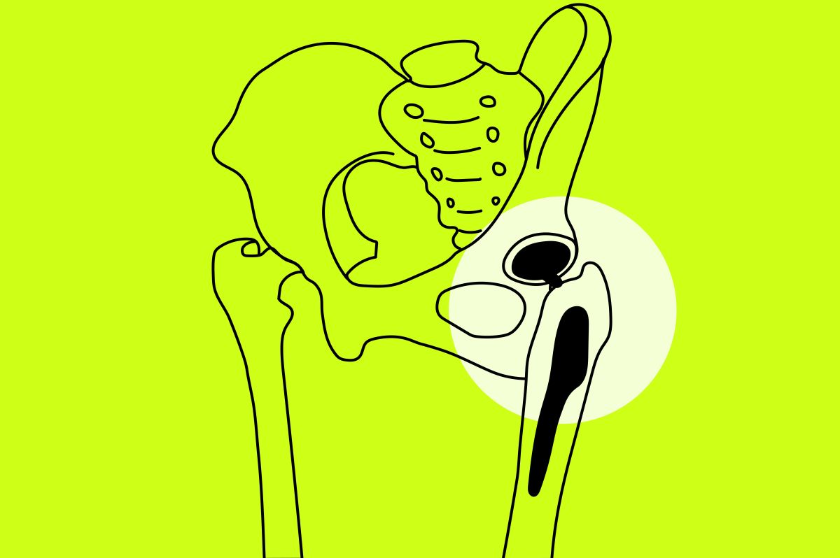 What are the benefits of robotic hip surgery? What are the benefits of robotic hip surgery?