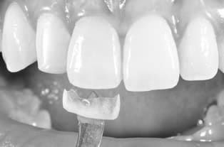 porcelain-veneers-thumbnail porcelain-veneers-thumbnail