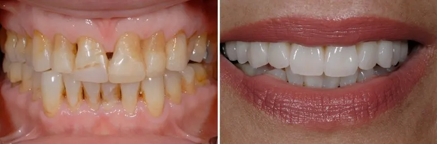 before-after-veneers before-after-veneers