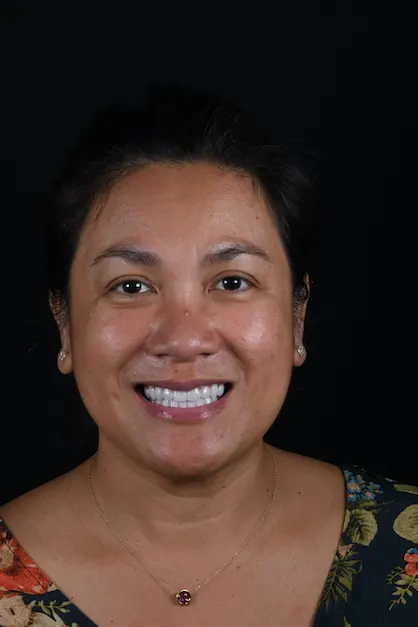 Dental Implants Happy Patient