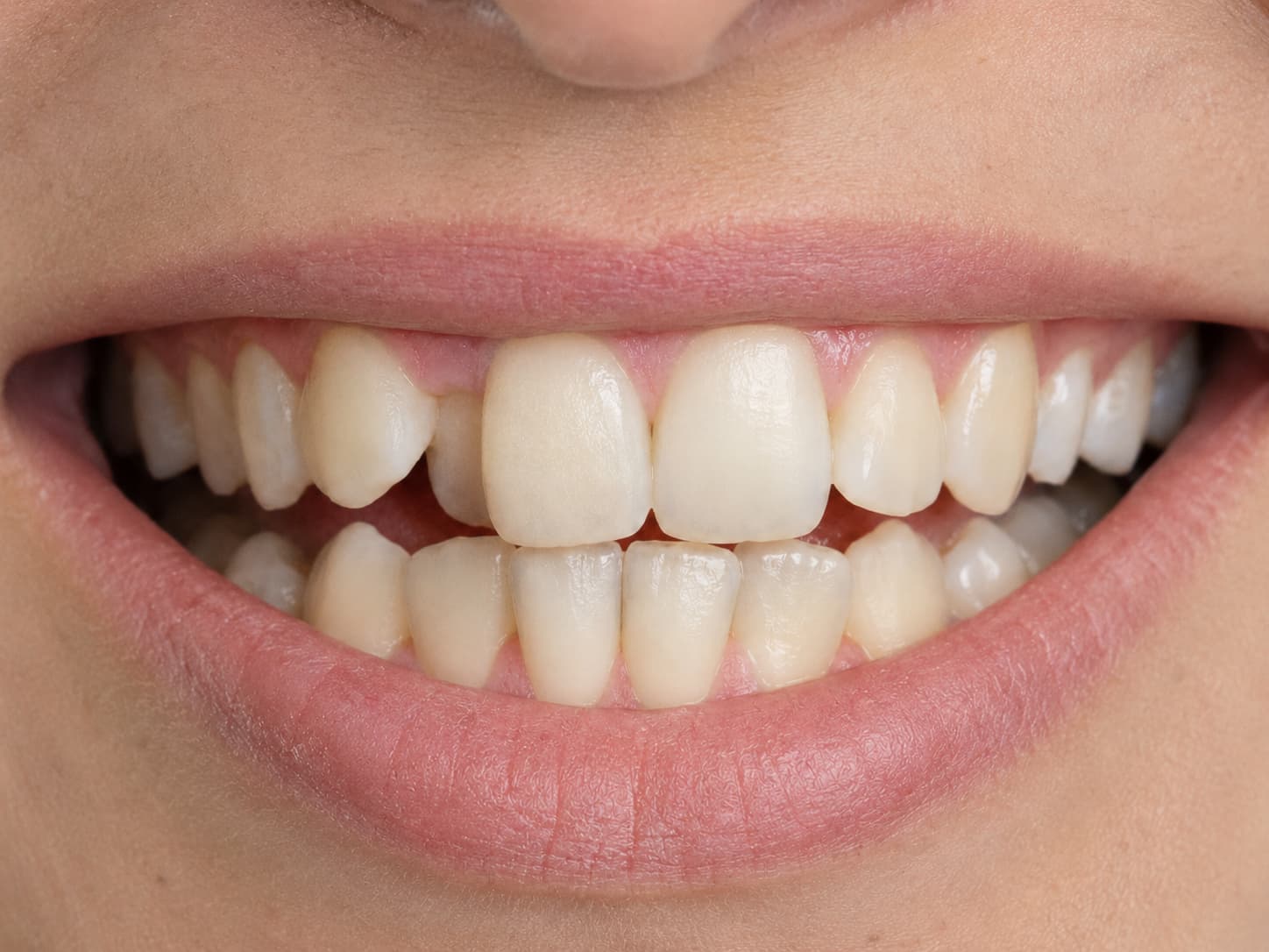 Teeth before treatment