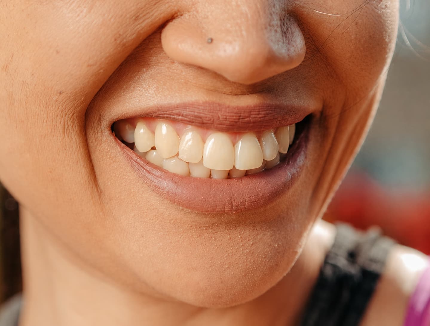 Teeth before whitening