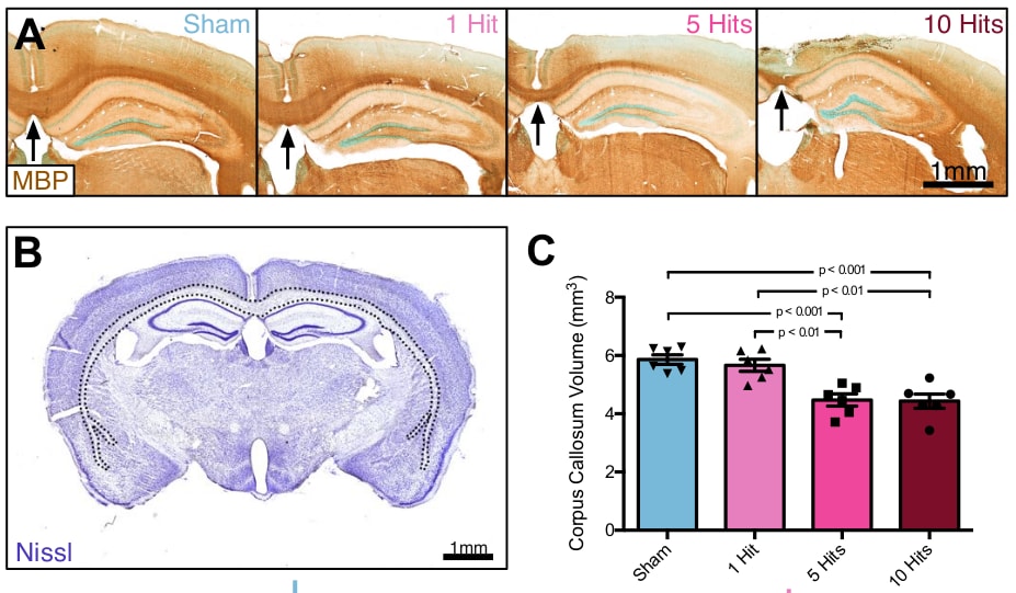 Infographic featuring 3 sections: A. Detailed brain scans showing the difference after repeated hits, from Sham to 1 hit then 5 hits then 10 hits; B. A full brain scan; C. A bar graph displaying data found in section A.