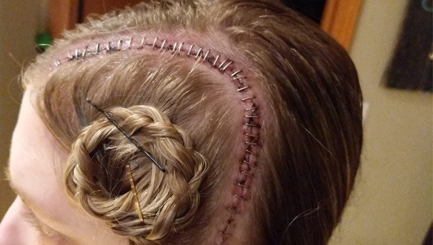 Image of Emily's head post-surgery with staples across her scalp.