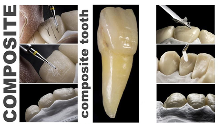 Composit tooth