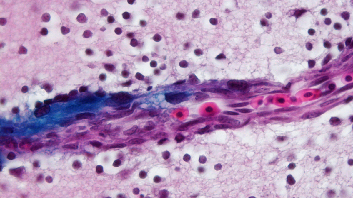 Galileo Lab: Brain Cancer Research