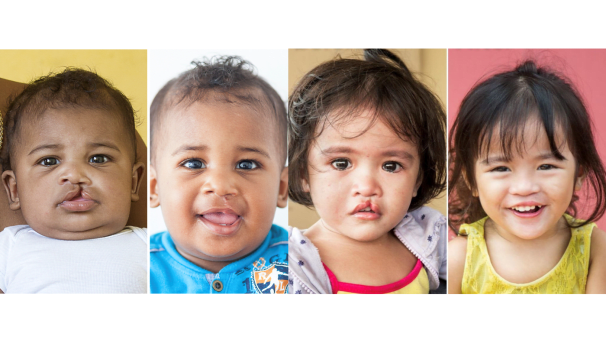 Change Lives by Supporting Emory Operation Smile Image