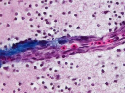 Galileo Lab: Brain Cancer Research Tile Image