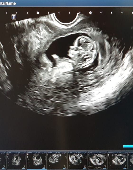 Book a private Pregnancy Dating scan near you