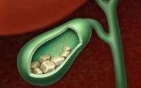 Understanding Cholelithiasis thumbnail