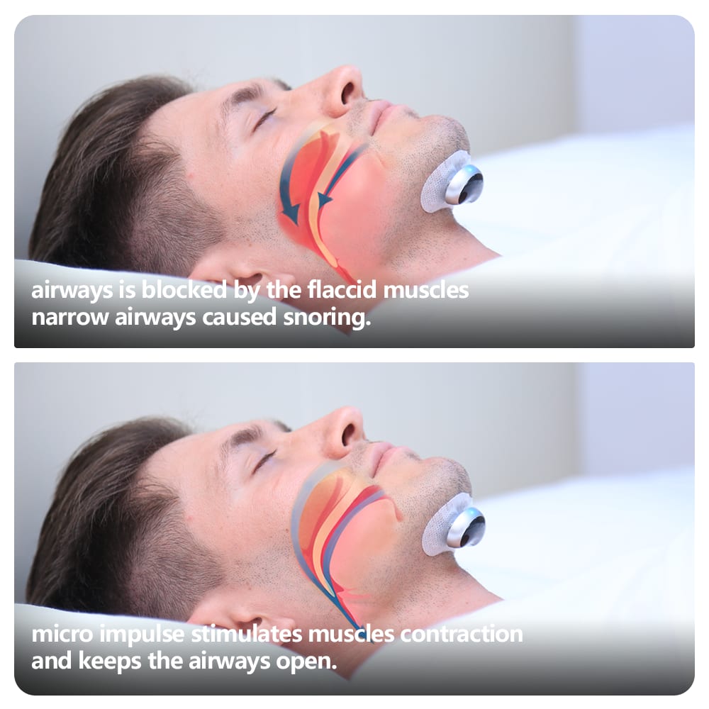 Smart Anti Snoring Device Electronic Muscle Stimulator view 12