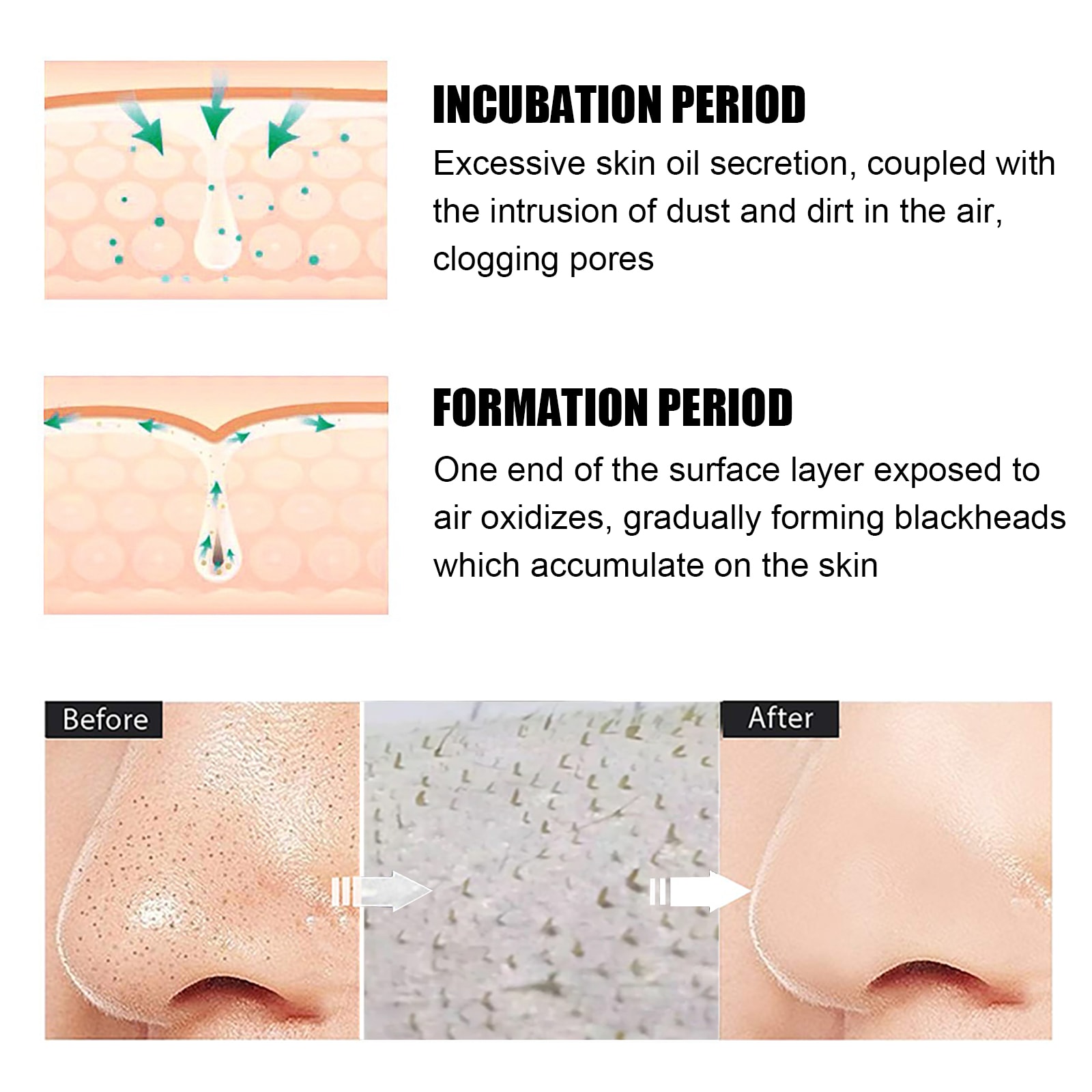 Blackhead Remover Tools -15g Blackhead Creamwith 40Pcs Blackhead Pore Strips view 4