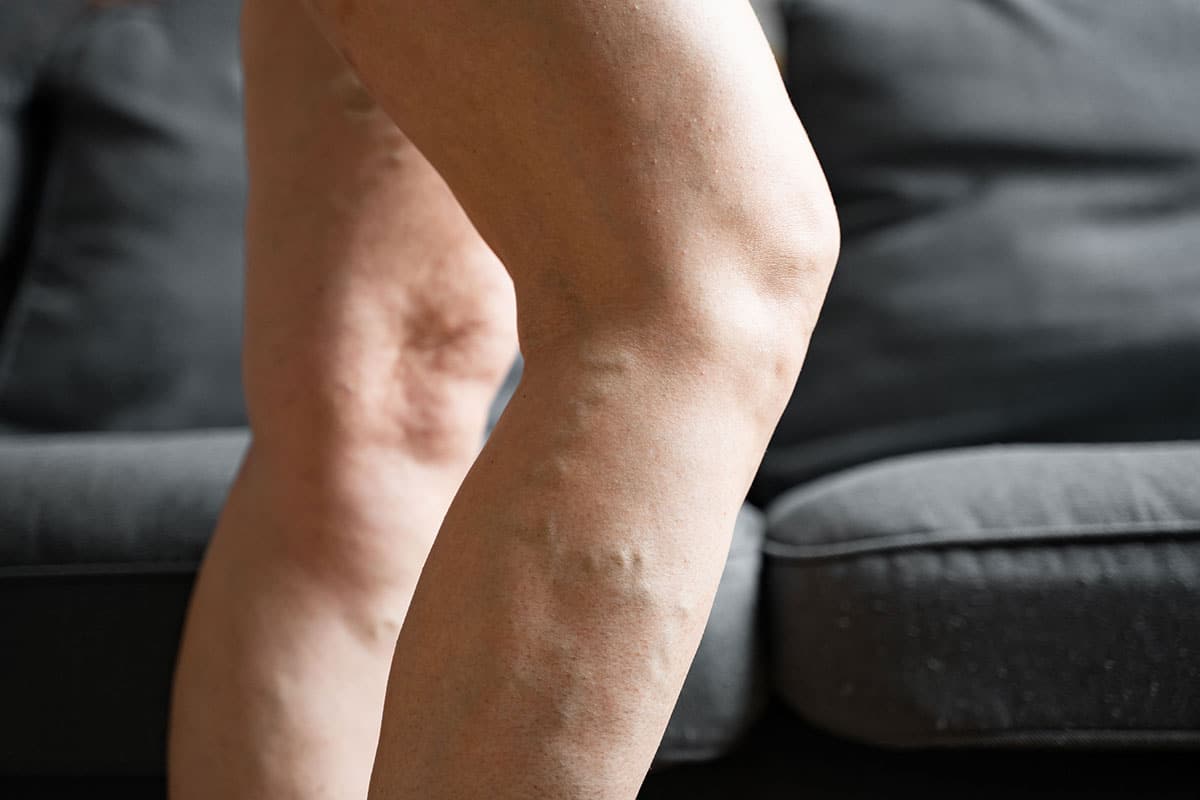 men and varicose veins