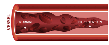 Illustration of a normal vessel and hypertensive vessel