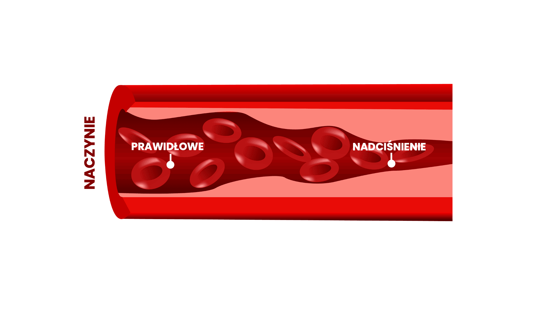 Nadciśnienie