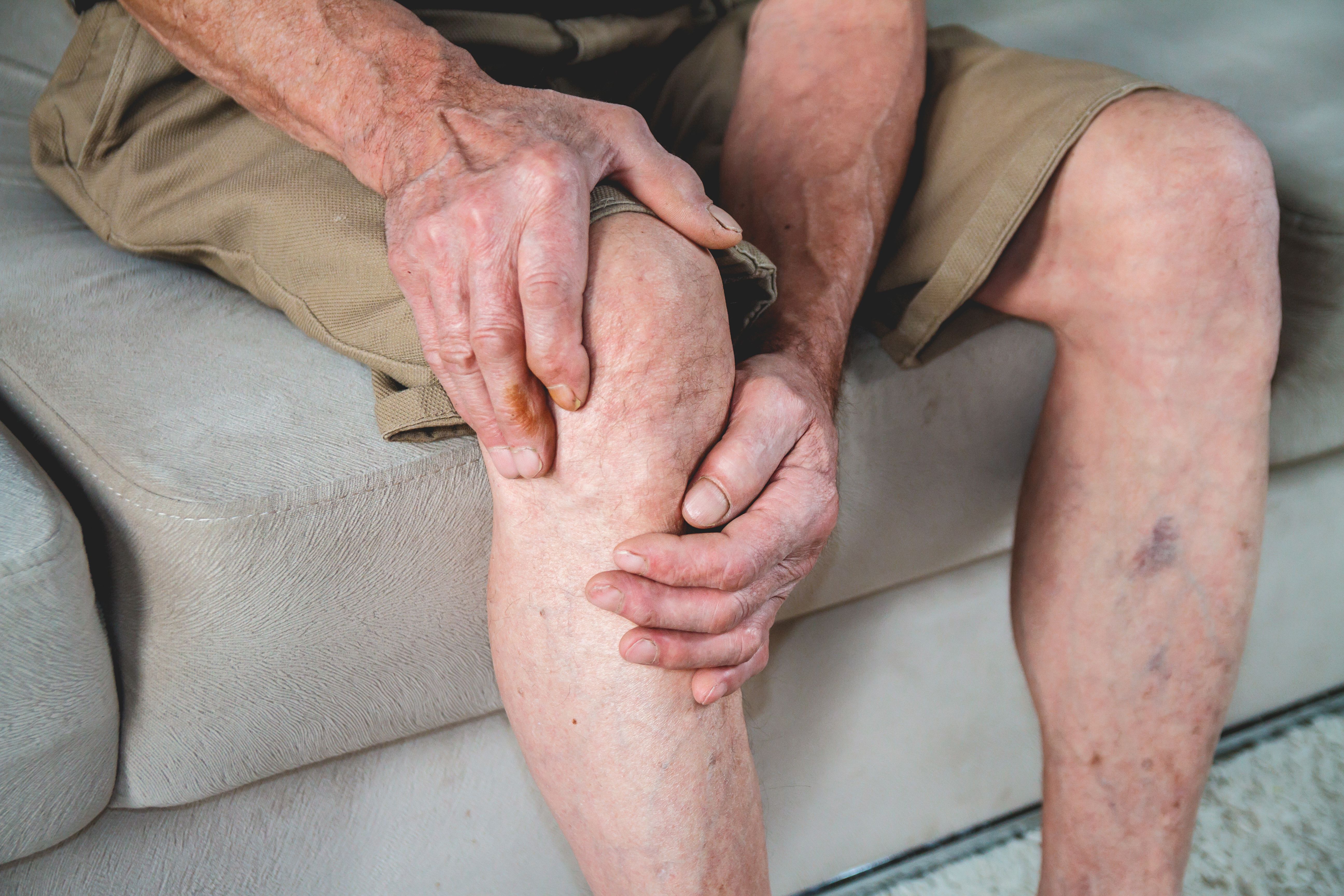 varicose veins in men