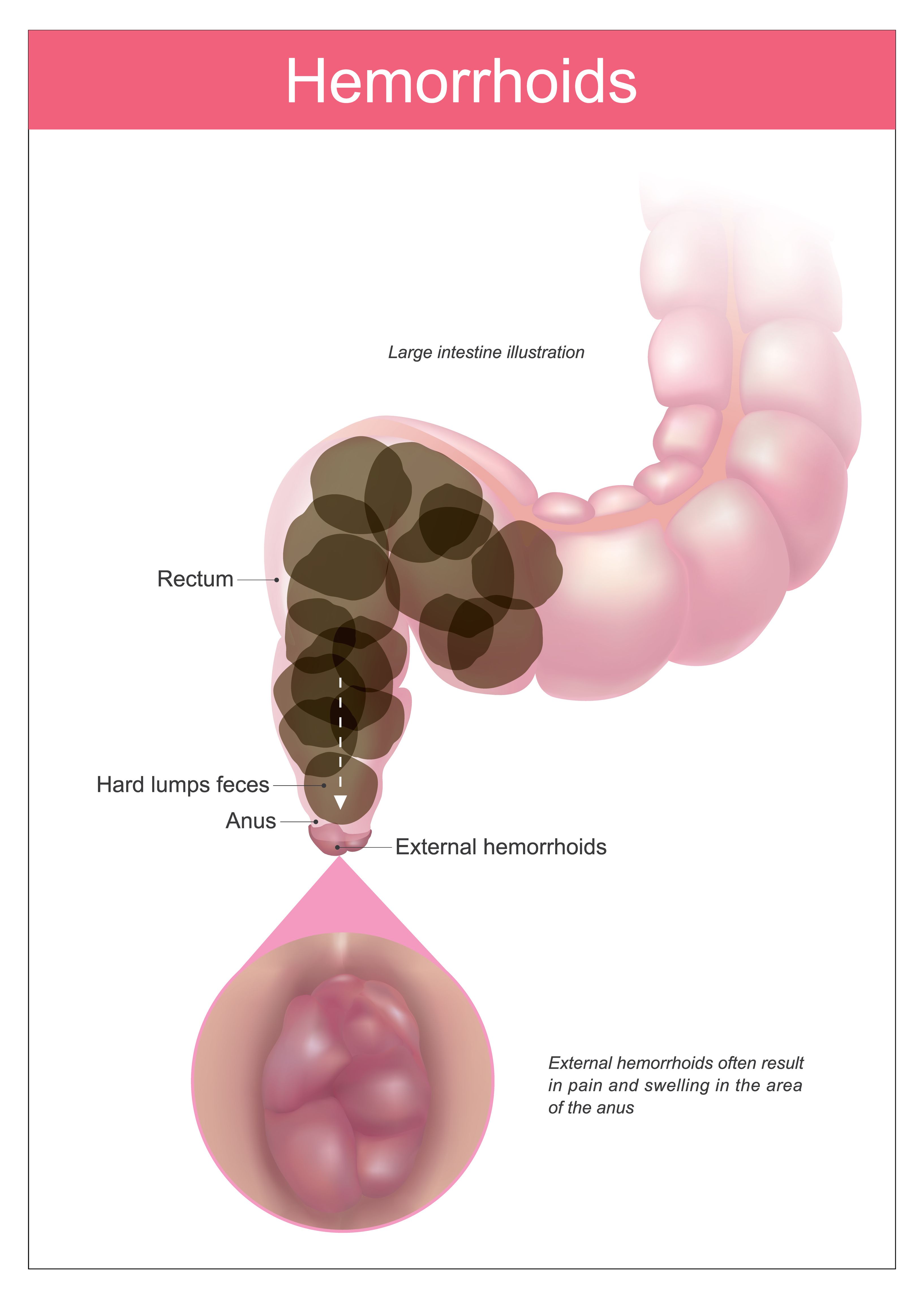 external hemorrhoids