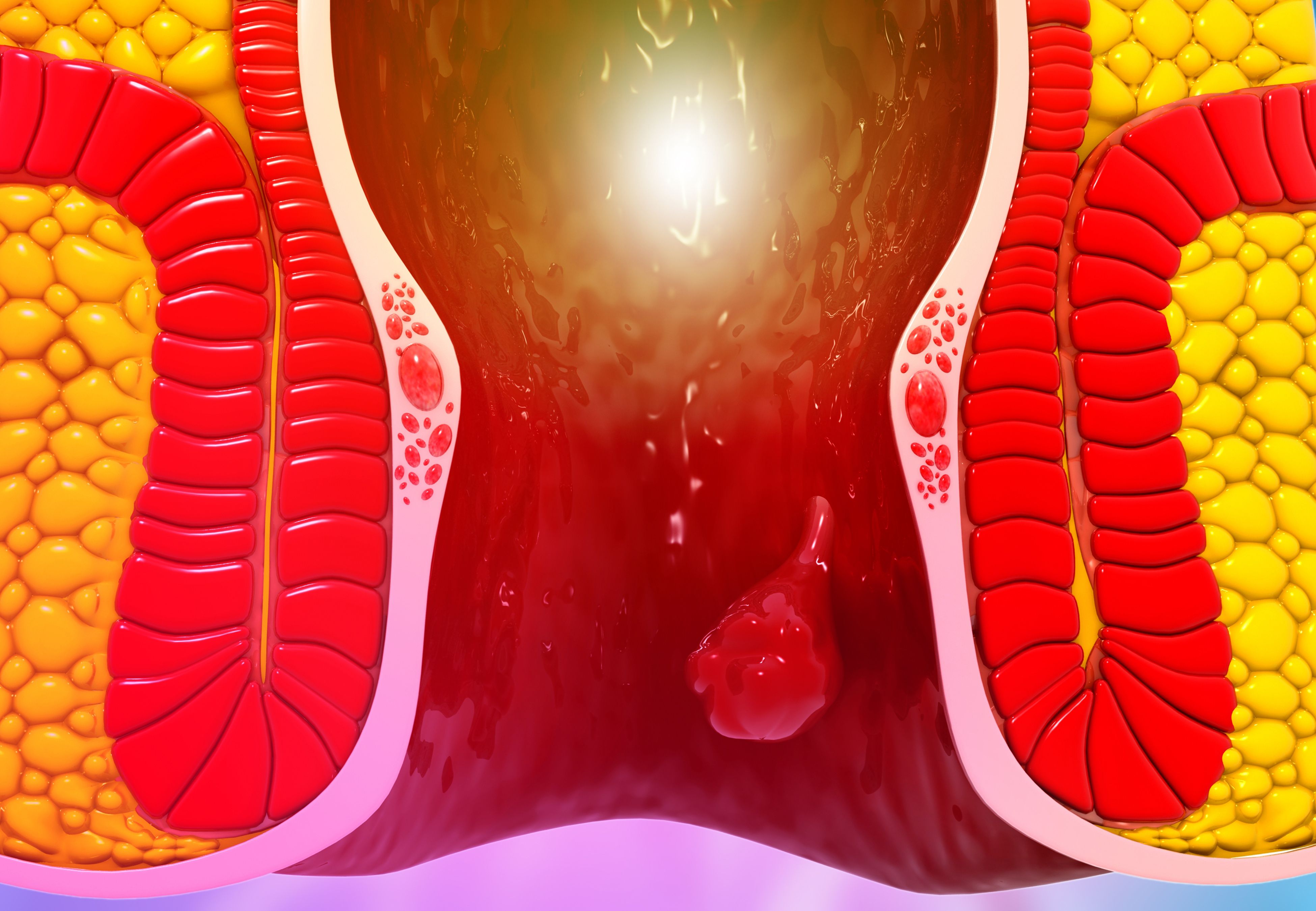 internal hemorrhoids