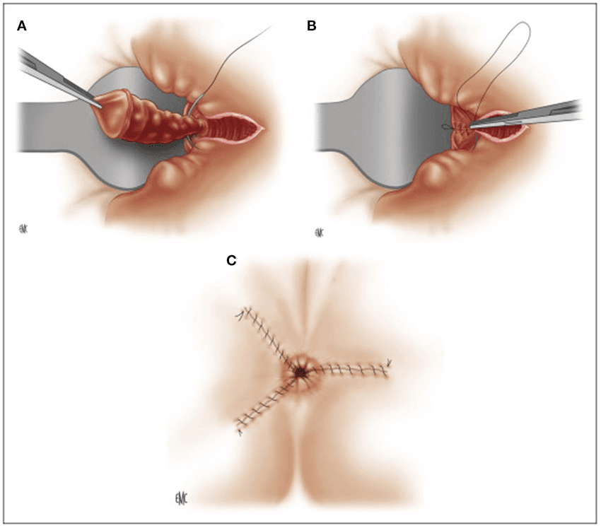 hemorrhoidectomy