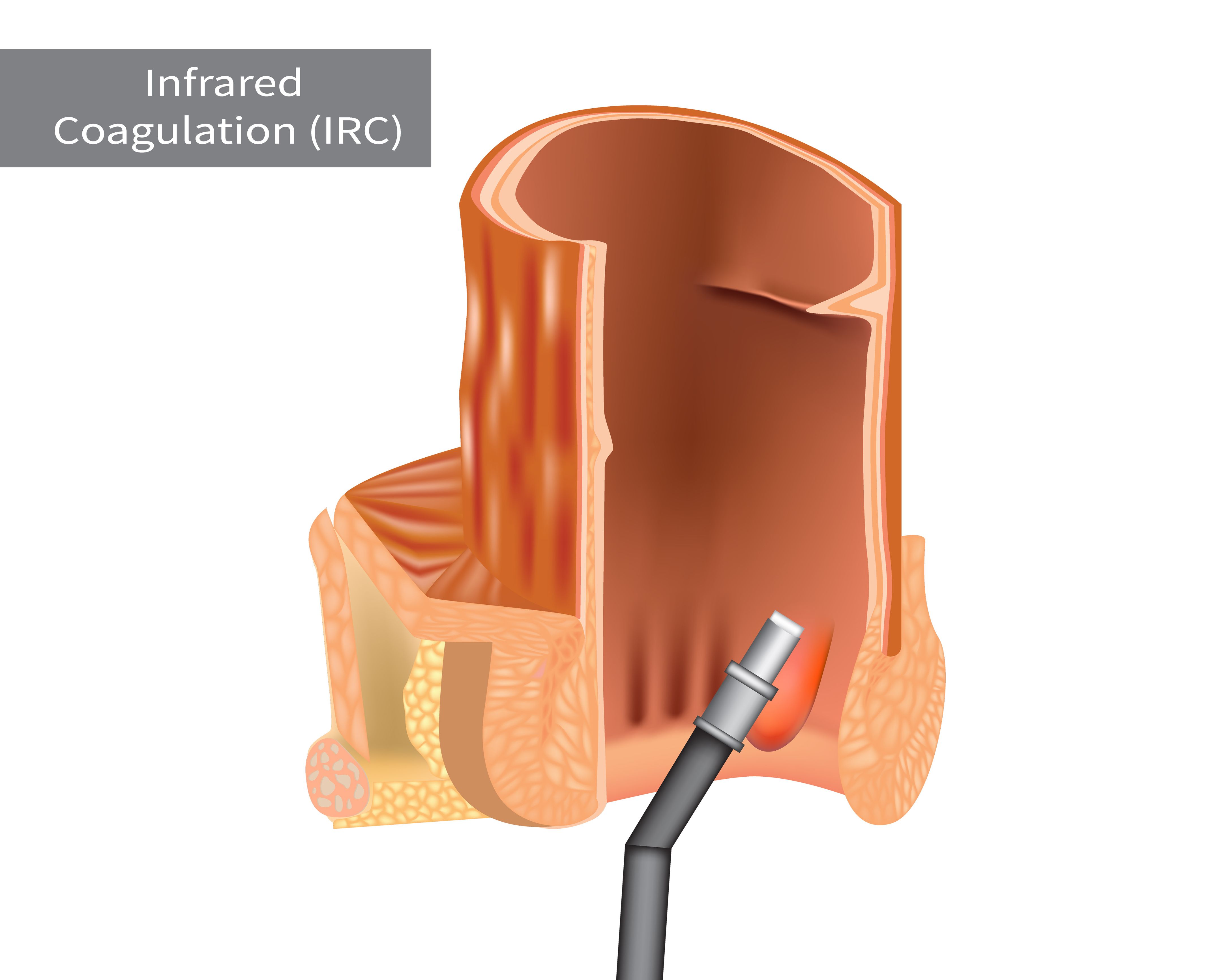 coagulation therapy for hemorrhoids