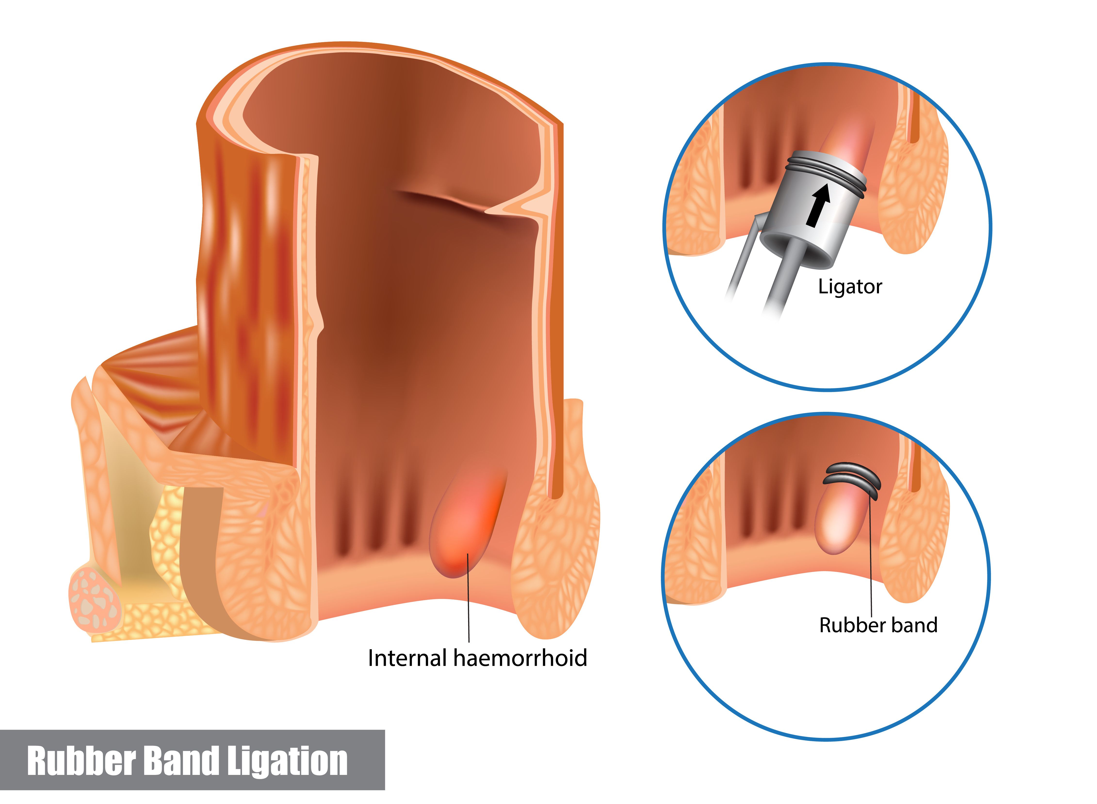 rubberband ligation for hemorrhoids