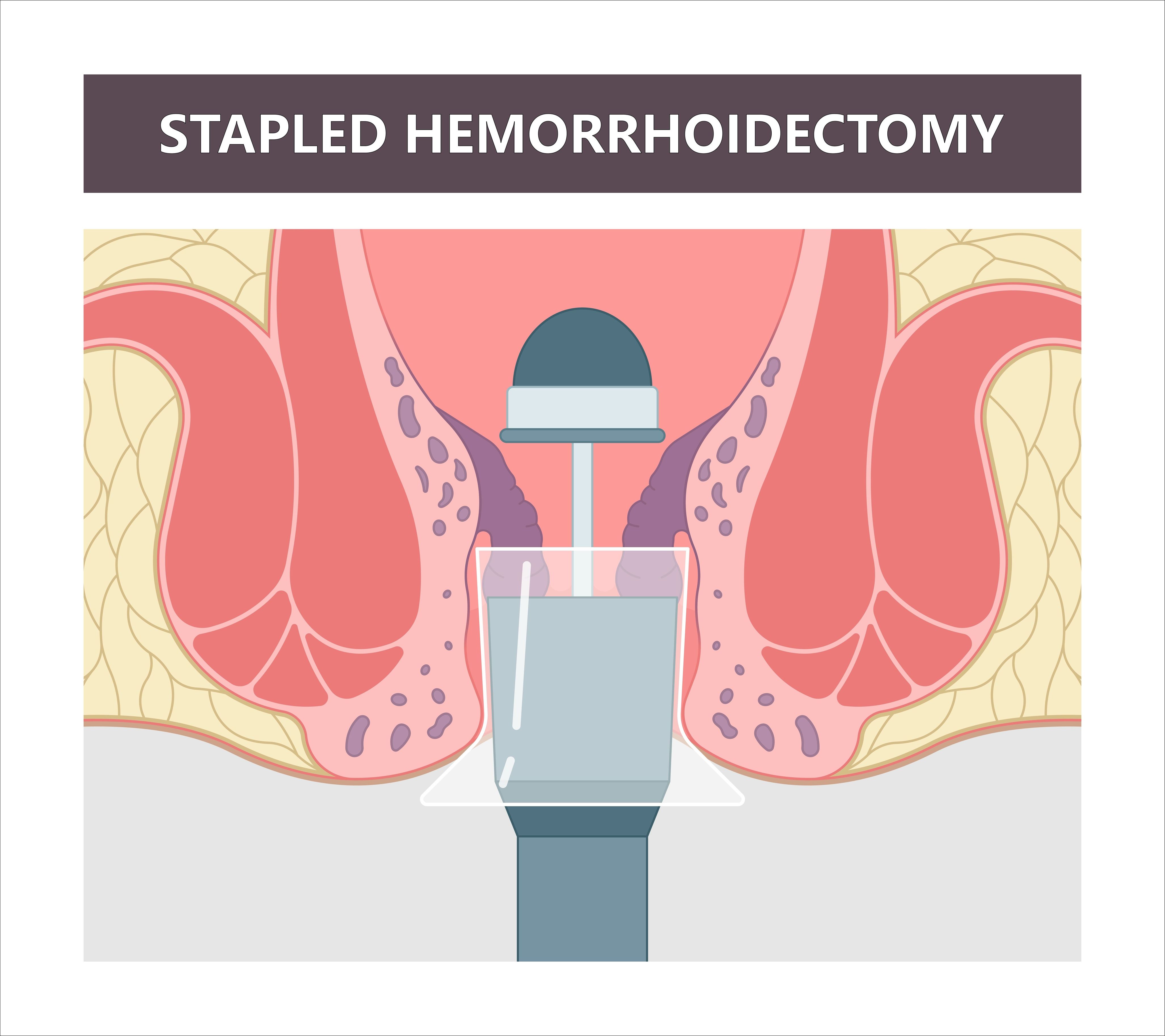 hemorrhoid stapling