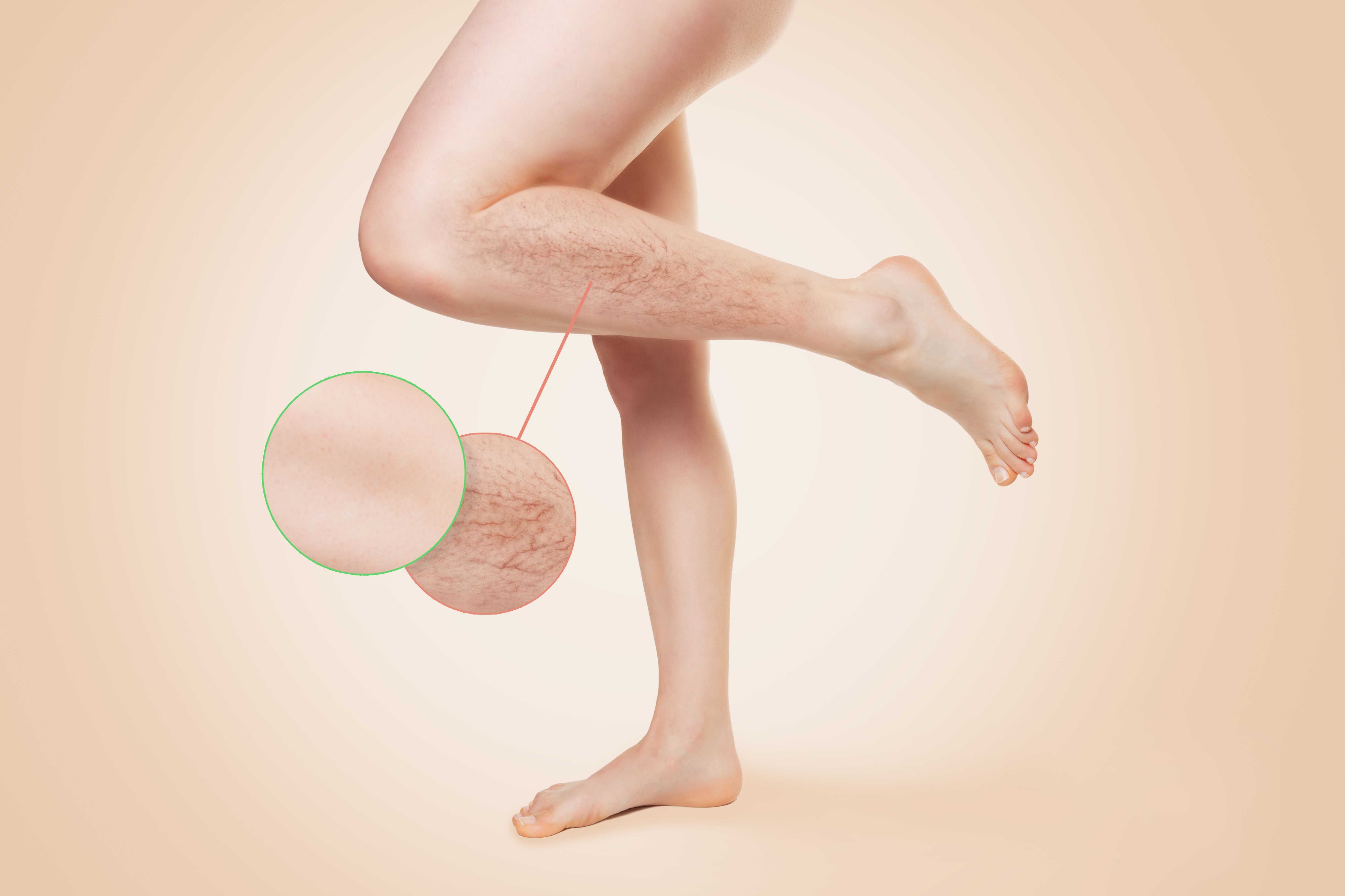 varicose veins