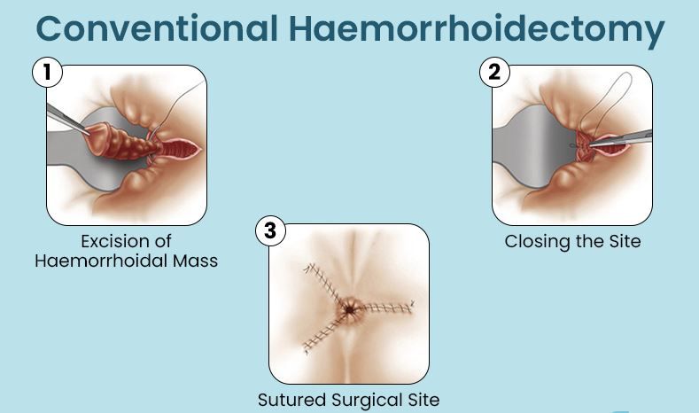 conventional hemorrhoidectomy