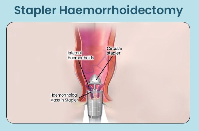 stapled hemorrhoidectomy