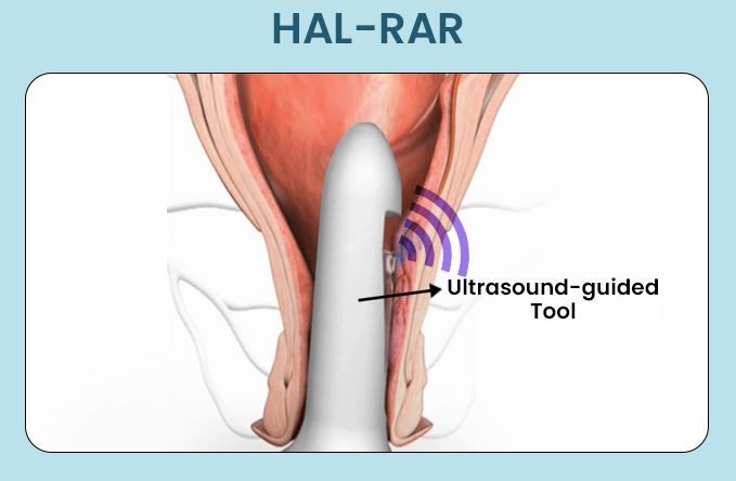 HAL-RAR procedure