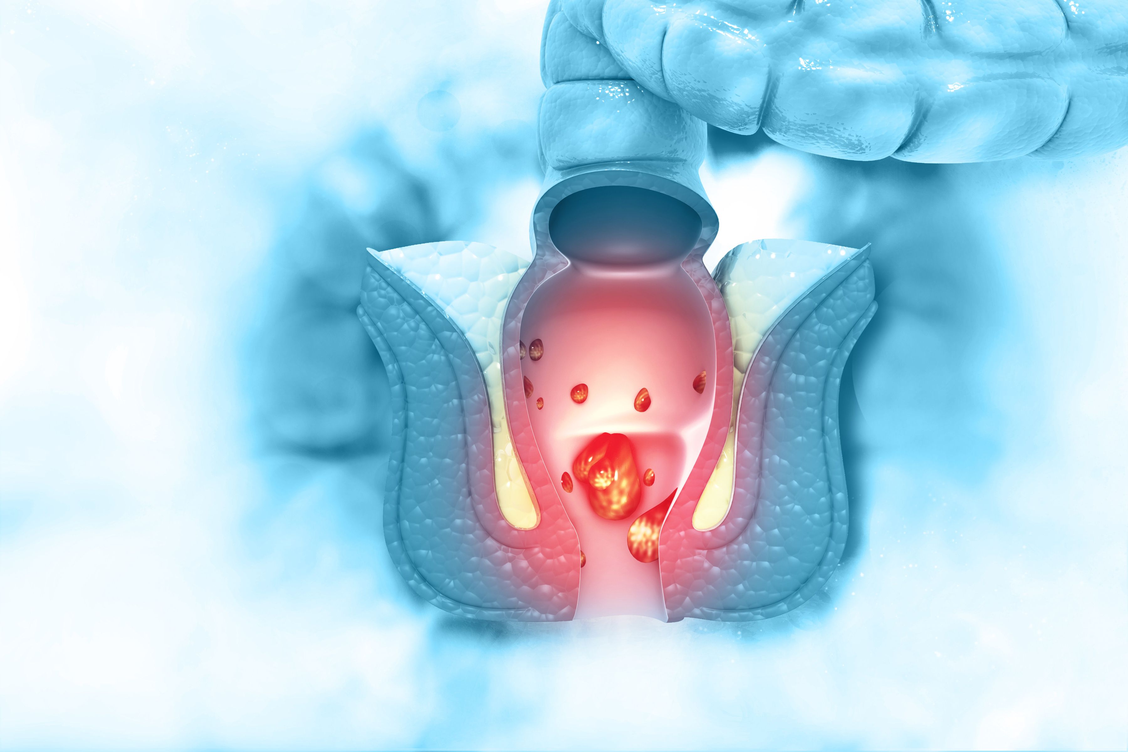 internal hemorrhoids