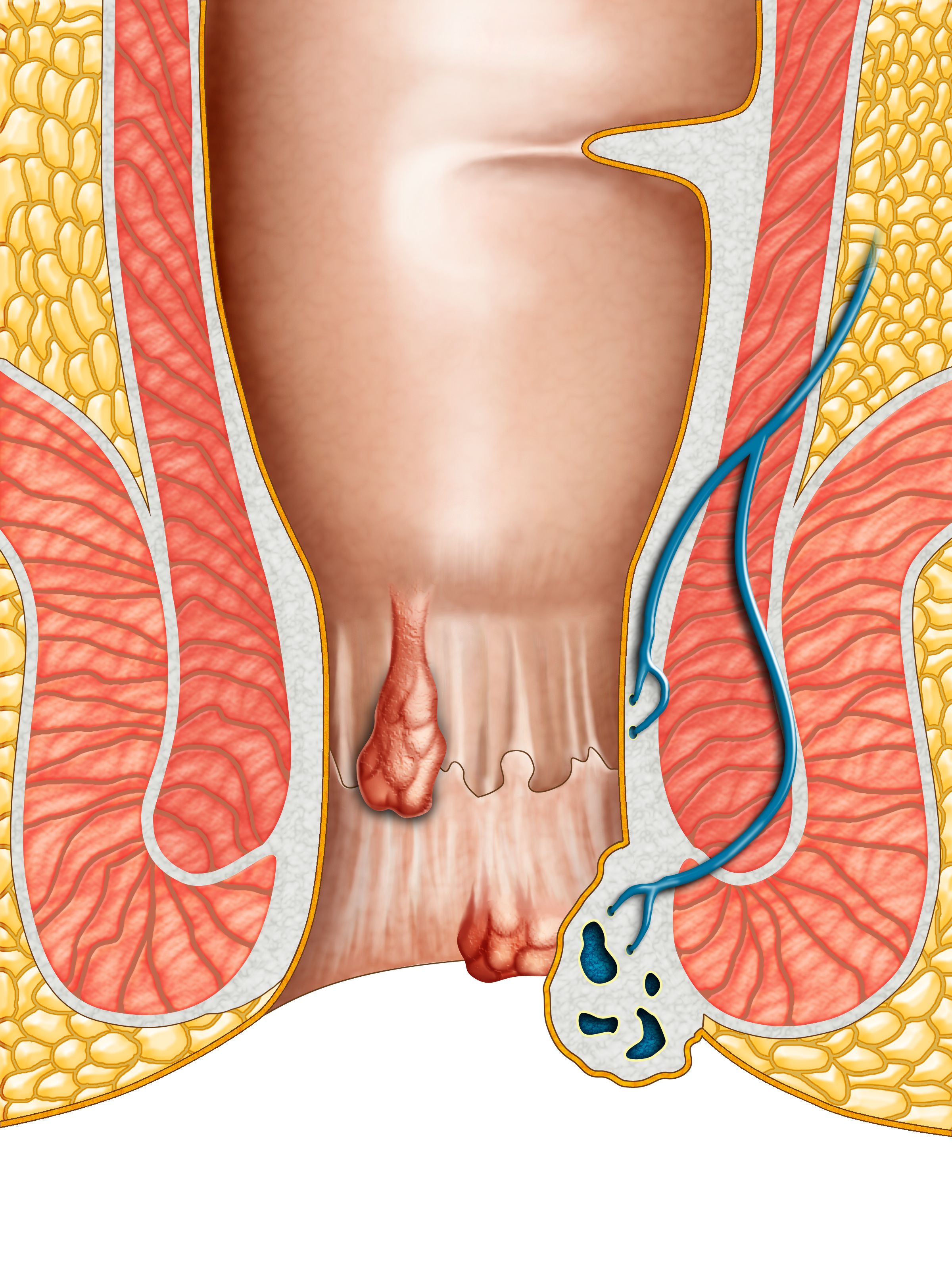 prolapsed hemorrhoids