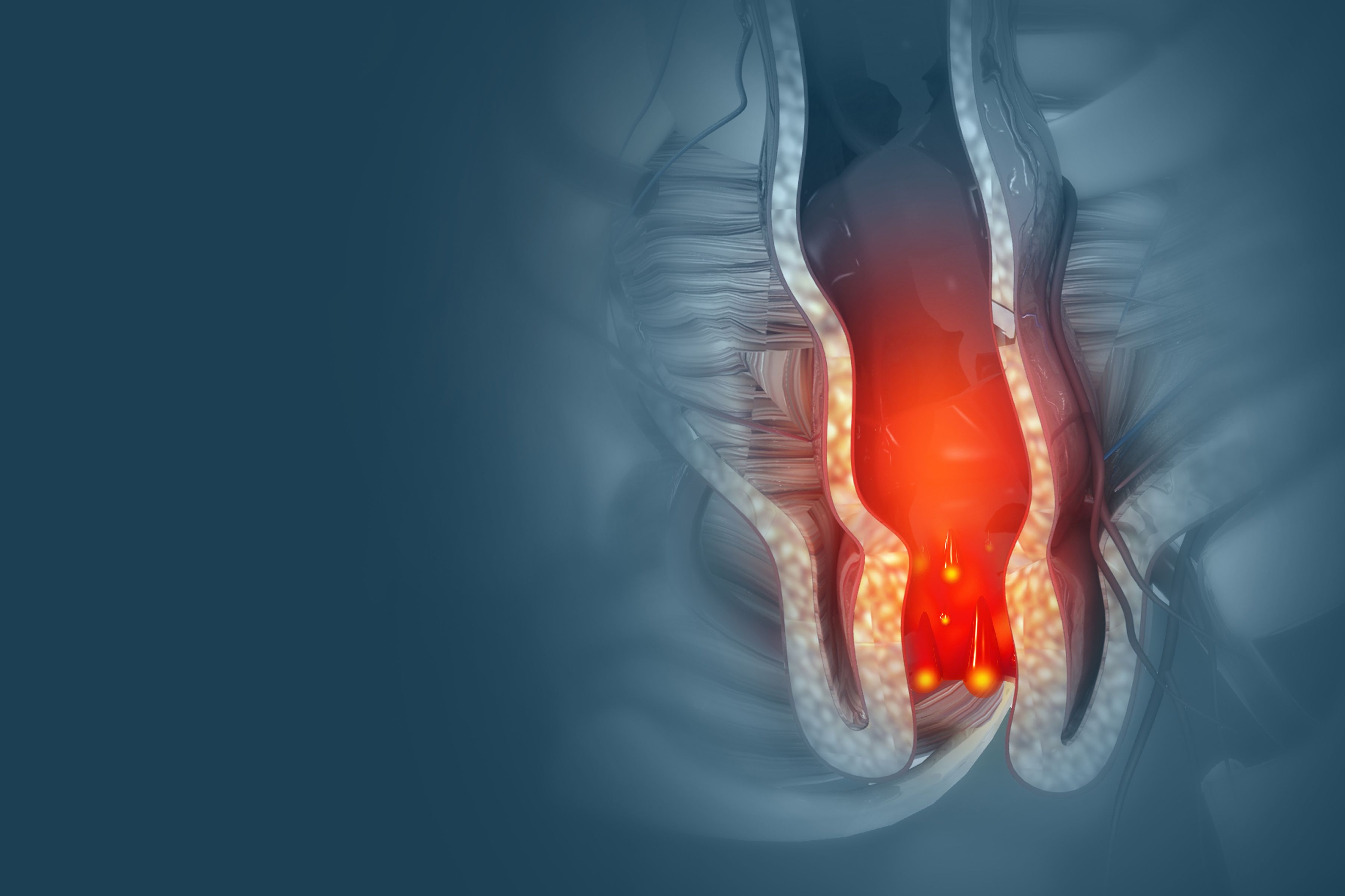 reduces inflammation of hemorrhoids