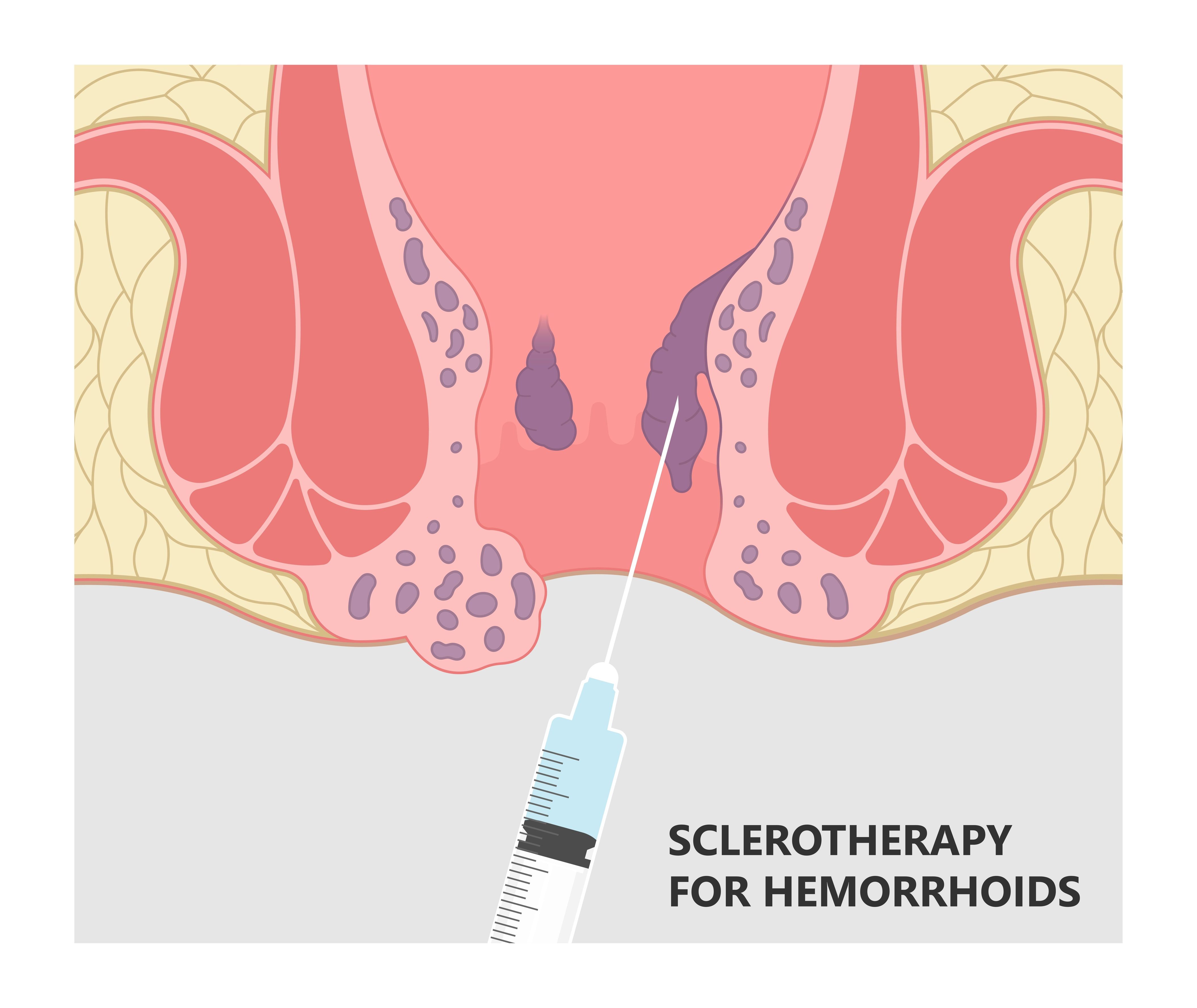 sclerotherapy para sa almoranas