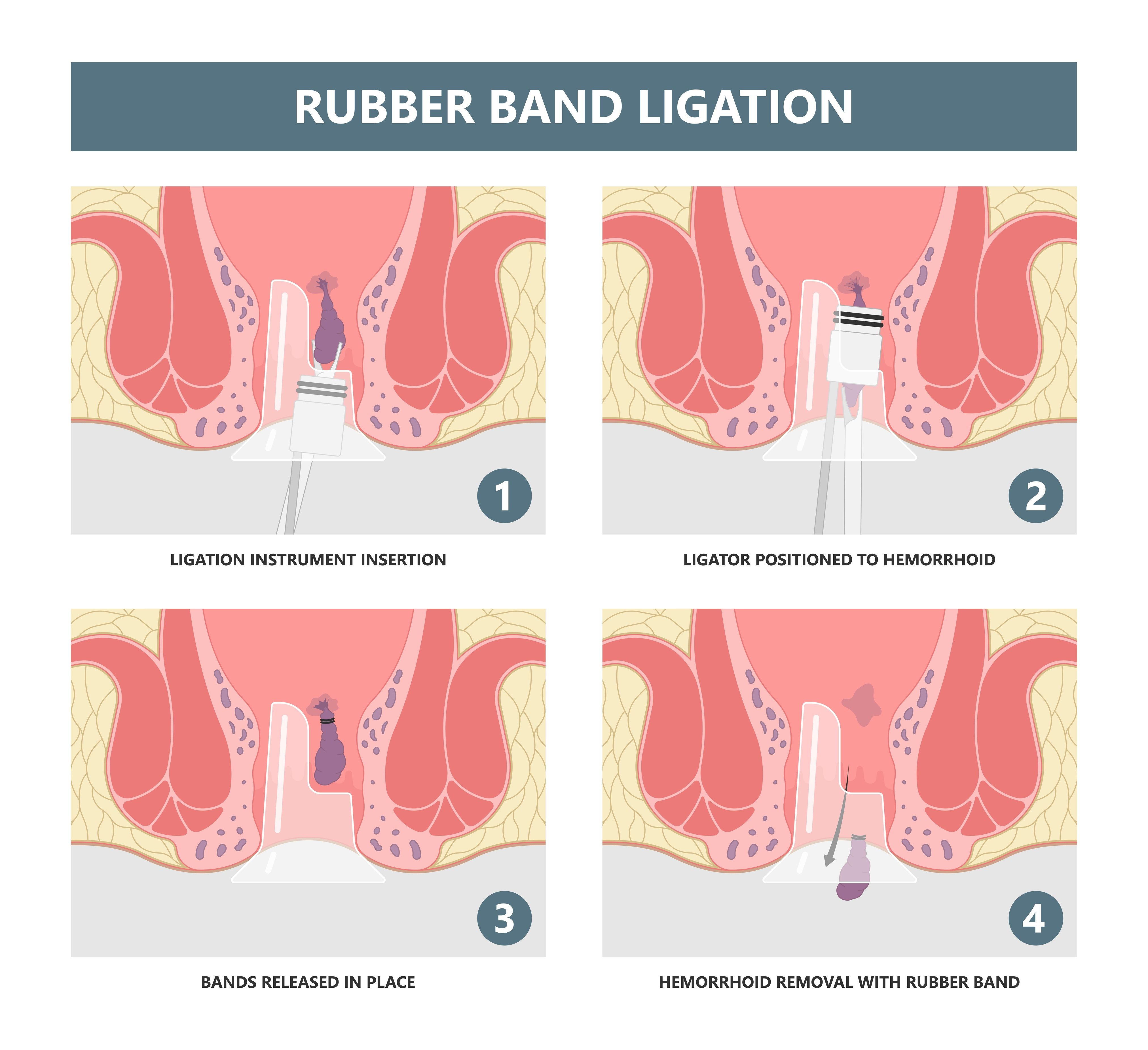 paano ginagawa ang rubberband ligation sa almoranas