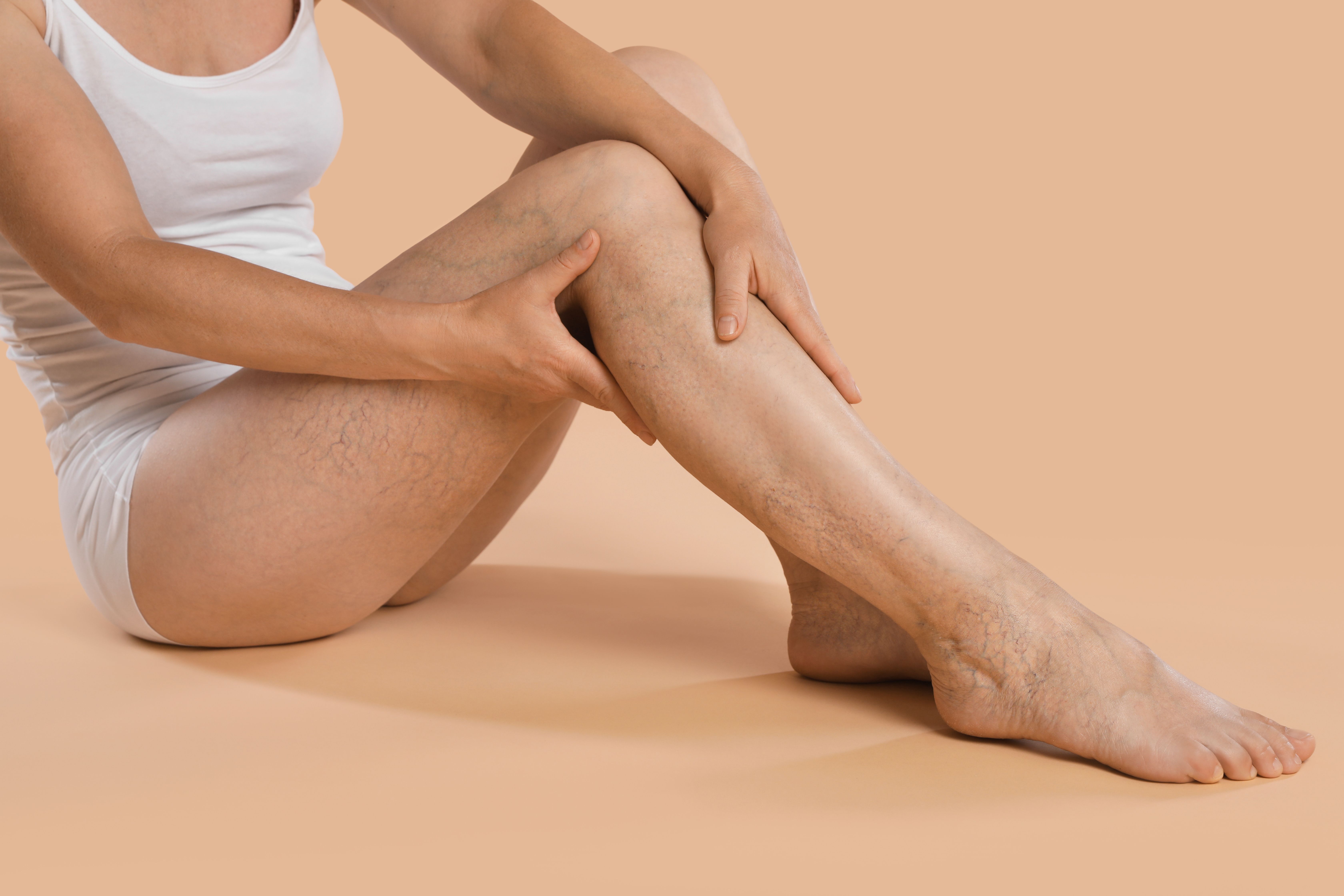 babaeng may vein disease