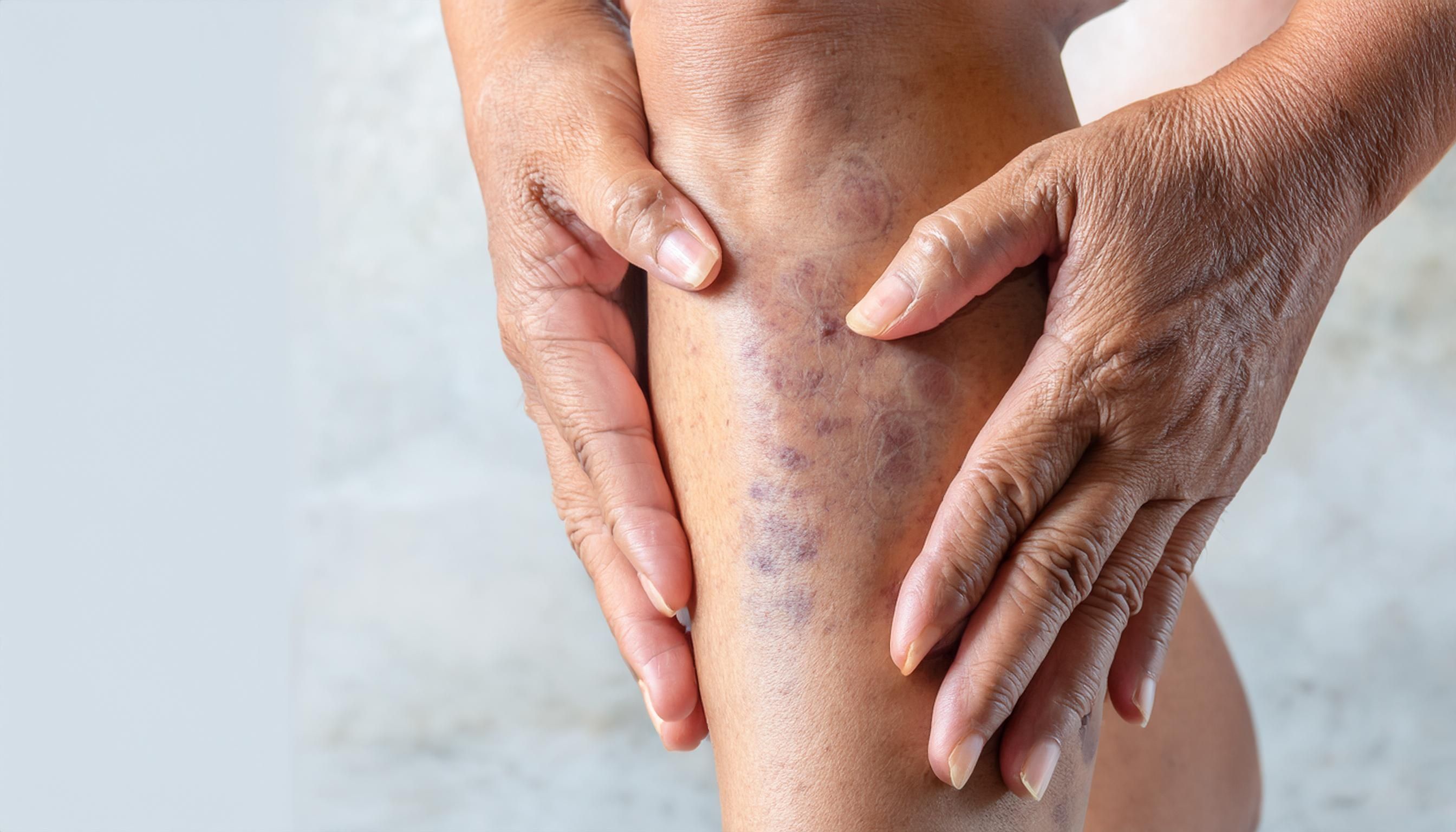 treatment options for chronic venous disease