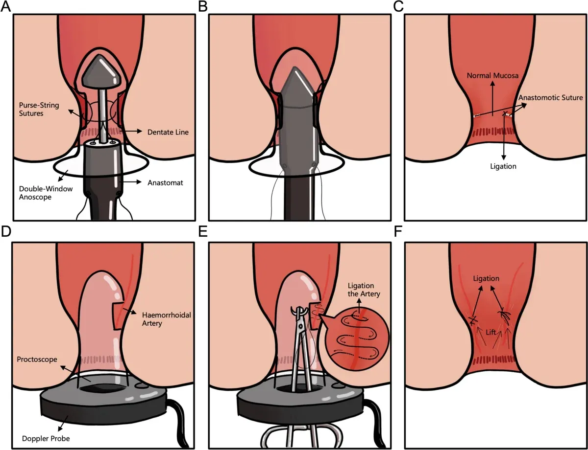 Doppler Guided Haemorrhoidal Artery Ligation